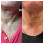 Lifting gât cu fusion plasma