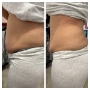 Liposonix