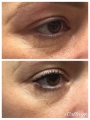 Blefaroplastia superioară cu fusion plasma