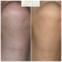 Rezultate hirsutism epilare definitiva brasov