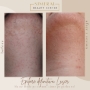 Rezultate before after epilare laser brasov