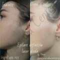 Epilare Definitivă Laser cu 4 Lungimi de Undă