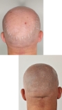 Alopecie avansata