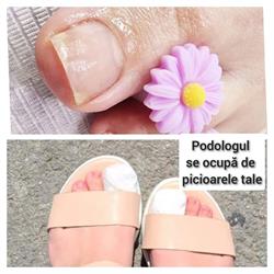 Podotim-Podologie -Tratament unghii incarnate Timisoara