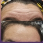 botox