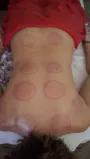 Dupa terapia cu ventuze