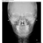Încărcat de vizitator în 02.09.2015  - Craniu Frontal AP/PA DIGITAL