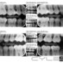 Încărcat de vizitator în 02.09.2015  - RADIOGRAFII INTERPROXIMALE - (BITE-WING) DIGITAL