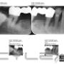 Încărcat de vizitator în 02.09.2015  - Radiografie dentara retroalveolara DIGITALA