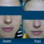 TRATAMENT PEELING CHIMIC ACNEE
