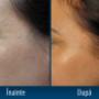 TRATAMENT RIDURI BOTOX