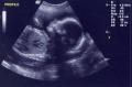 ECOGRAFIA DE MORFOLOGIE FETALA
