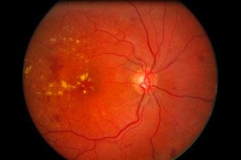 Retinopatie-diabetica