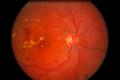 Fotocoagularea laser in retinopatia diabetica