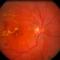 Retinopatie-diabetica