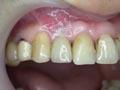 implant dentar