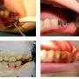 Caz coaroana pe implant dentar