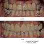 Punte metalo ceramica