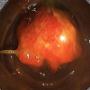 Cancer colon