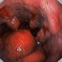 Esofagita de reflux