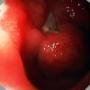 Ulcer bulbar