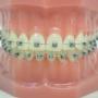 aparat dentar classic