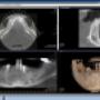 CT CBCT MANDIBULAR