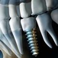 Implantologie Si Chirurgie