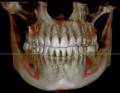 CBCT