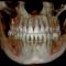 CBCT-BIMAXILAR